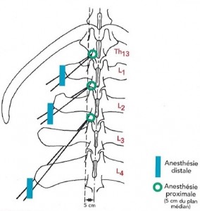 Figure 15: Repérage des lieux d'injection lors d'anesthésie paravertébrales