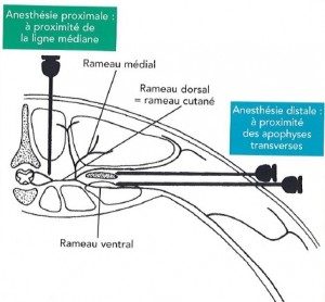 Figure 16 : Schéma de l'emplacement des aiguilles lors d'injections paravertébrales proximale et distales