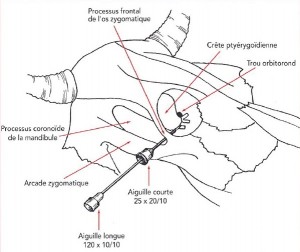 anesthésie de l'oeil : méthode de peterson