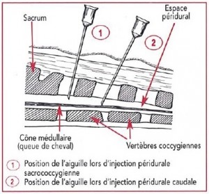 Figure 46 : Positionnement de l’aiguille lors d’anesthésie péridurale –Référence bibliographique n°10, page 13